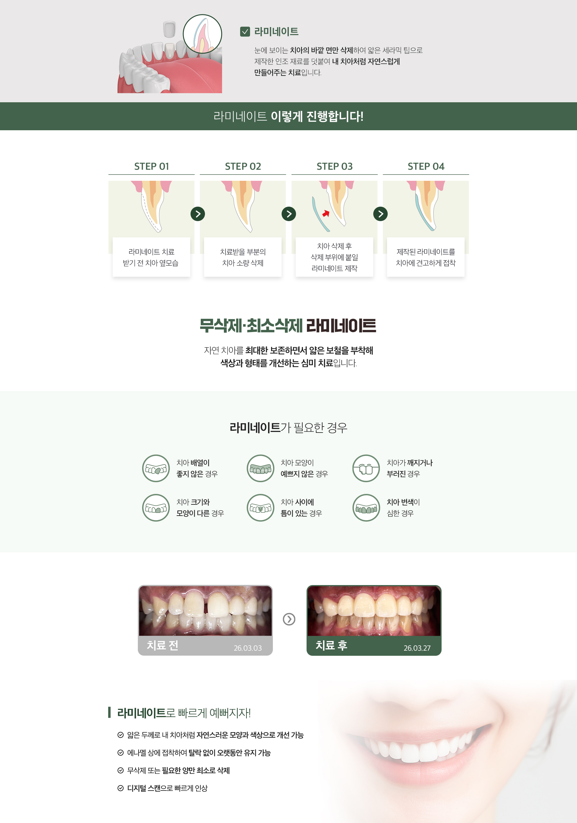 가우정치과 최소삭제 라미네이트