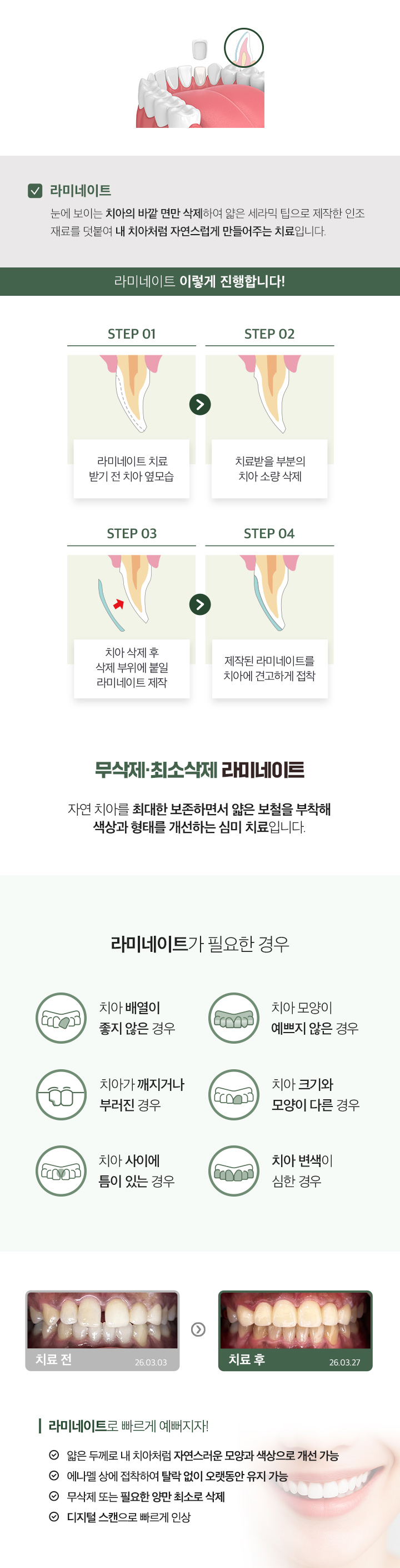 가우정치과 최소삭제 라미네이트